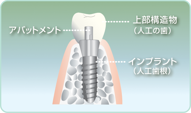 インプラントの構造